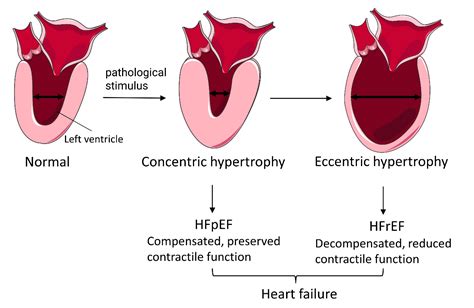 eccentric lv hypertrophy|eccentric vs concentric cardiac hypertrophy.